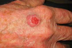 سرطان سلول‌های سنگفرشی یک نوع سرطان پوست